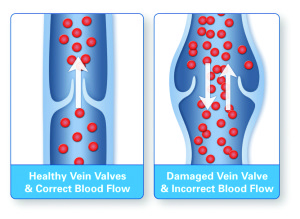 Venous Insufficiency - Healthy vs. Diseased Valves