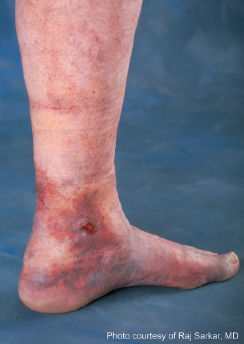 Venous Ulceration