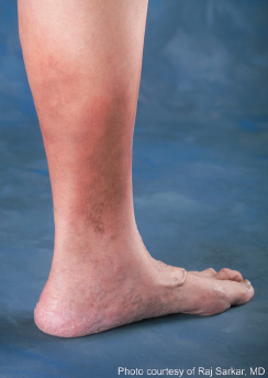 Leg Swelling