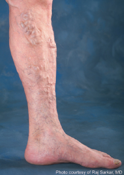 Varicose Vein Treatment