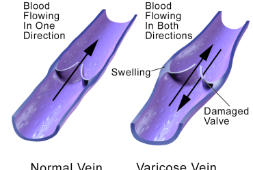 What is Chronic Venous Disease?